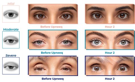 <strong>UPNEEQ</strong>® – the name of RVL’s new venture into eye health, helps to open your eyes by improving low-lying lids with a once daily dose. . Upneeq vs afrin